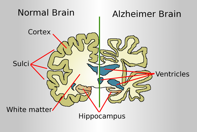 Global Dementia Prevention Research Project