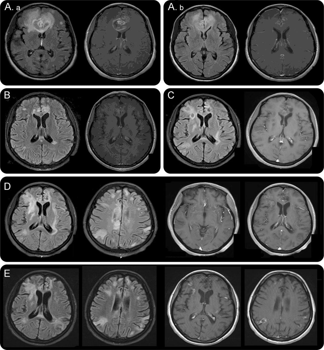 Schizophrenia Is Chronic Encephalitis