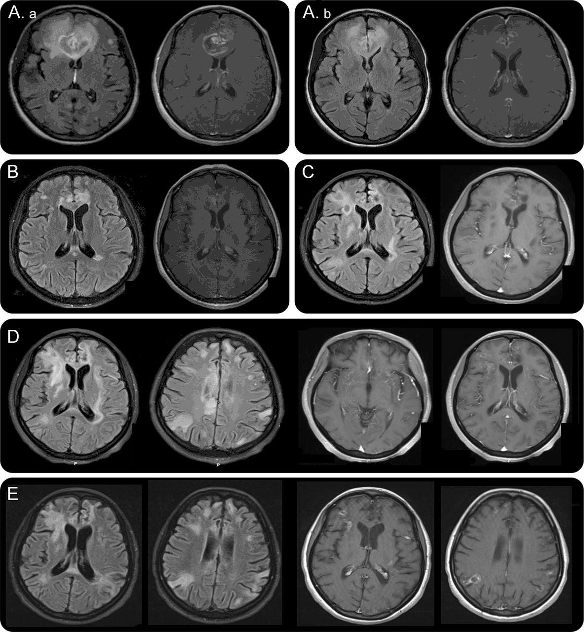Schizophrenia Is Chronic Encephalitis
