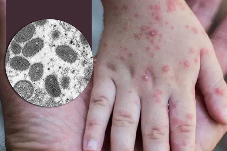 Monkeypox Infection To Fear or Not to Fear?