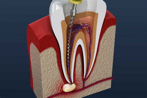 Root Canals Frequently Cause Breast Cancer