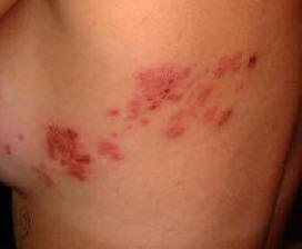 Natural Help for Shingles