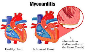 Myocarditis: Once Rare, Now Common