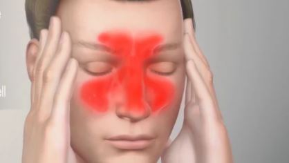 Sinusitis